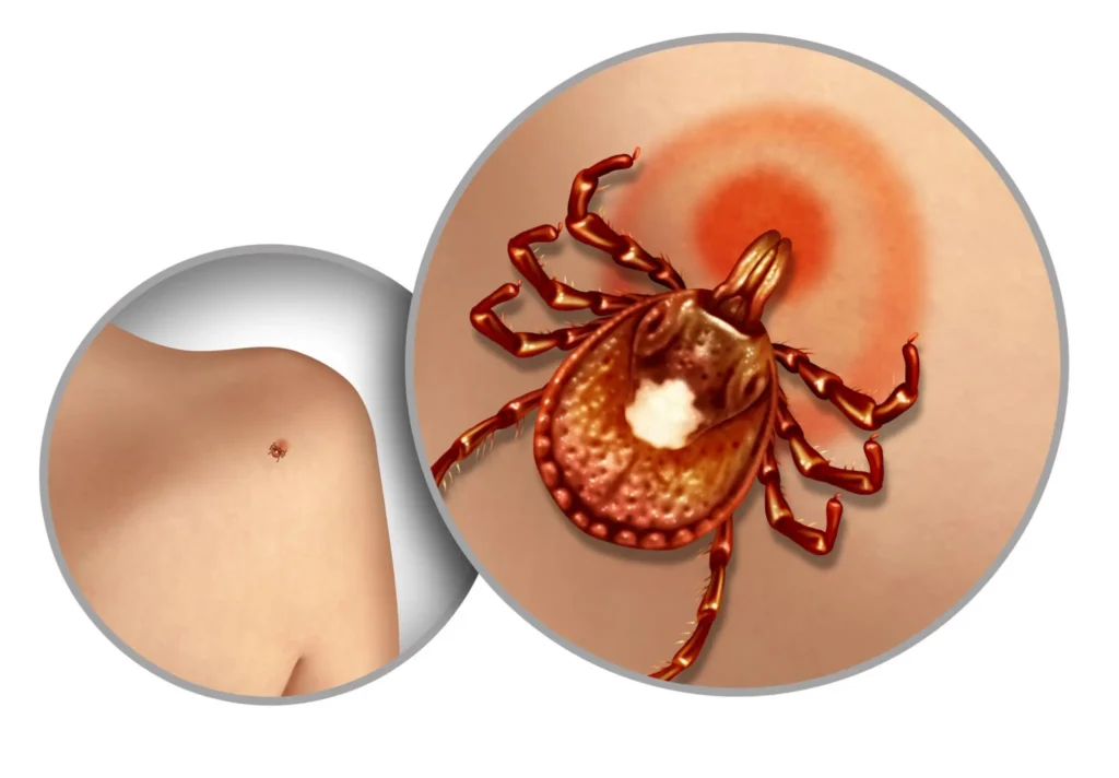 tick-bite-alpha-gal-syndrome